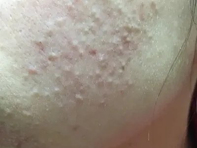 化妆品性痤疮白头粉刺图片