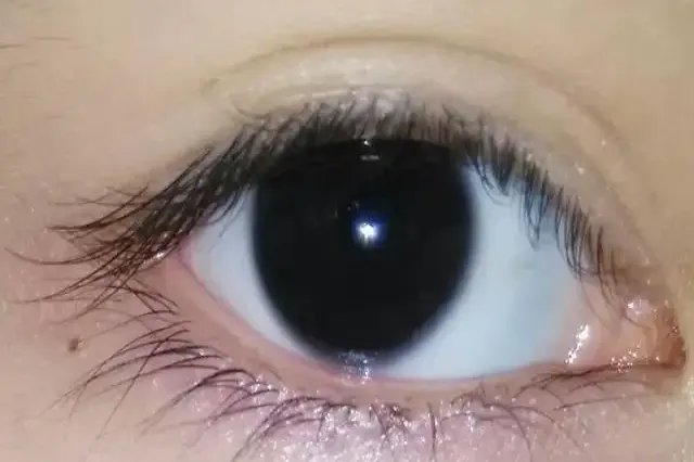 瞳孔散大图片大全