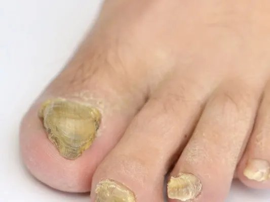 脚指甲不平怎么回事