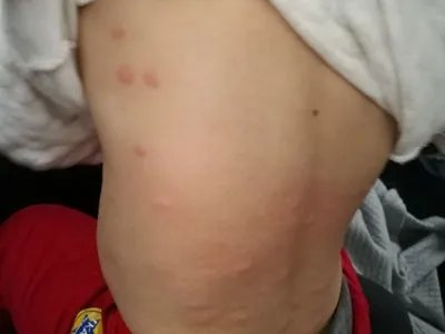 跳蚤叮咬疙瘩图片