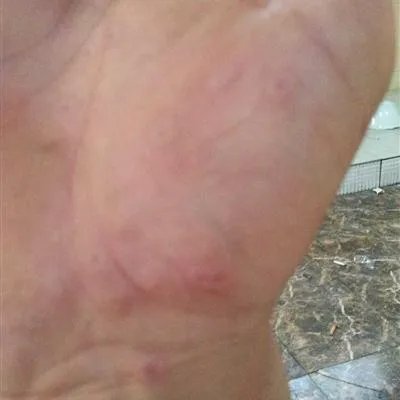 风疹病毒阳性怎么治疗