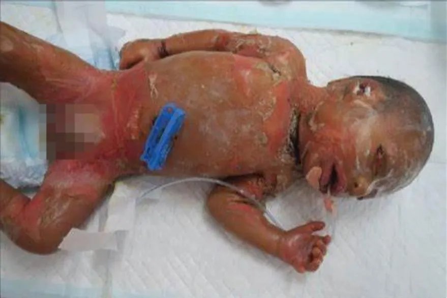 火棉胶样婴儿图片