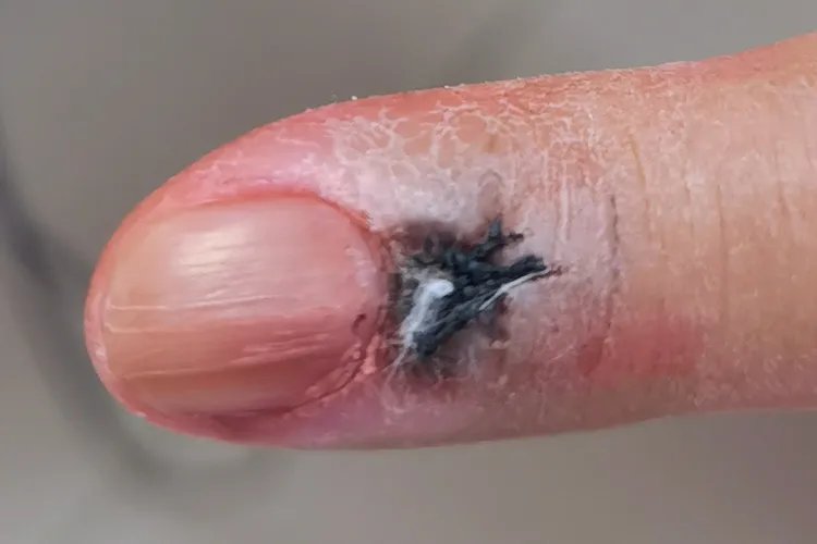 黑色素瘤早期症状图片