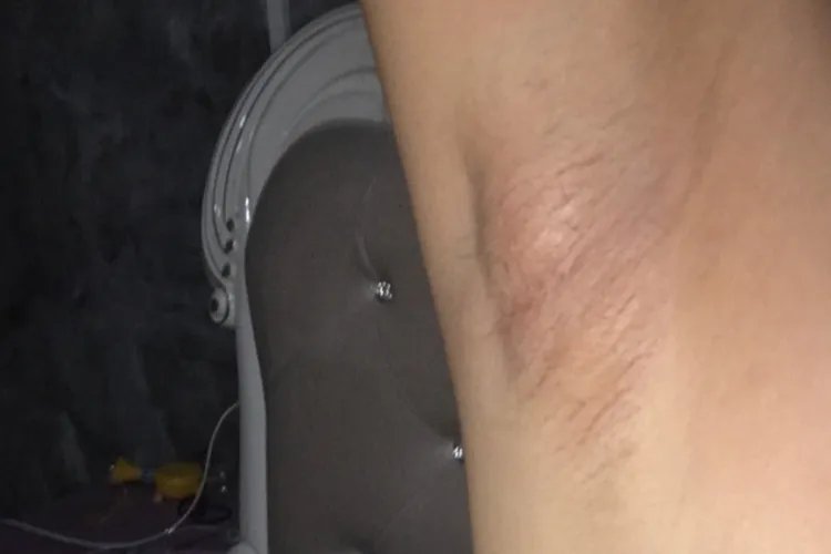 男人腋下淋巴癌早期症状图片