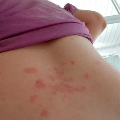 虫咬有什么症状