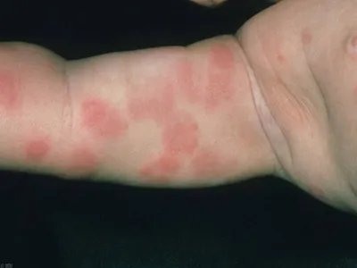 皮肤过敏红肿胳膊症状图片