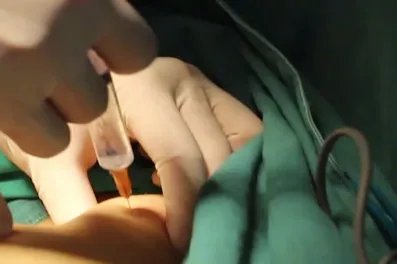 男士假体隆胸图片