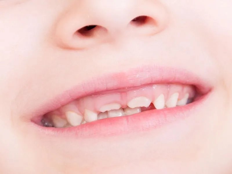 怎样进行凸嘴手术