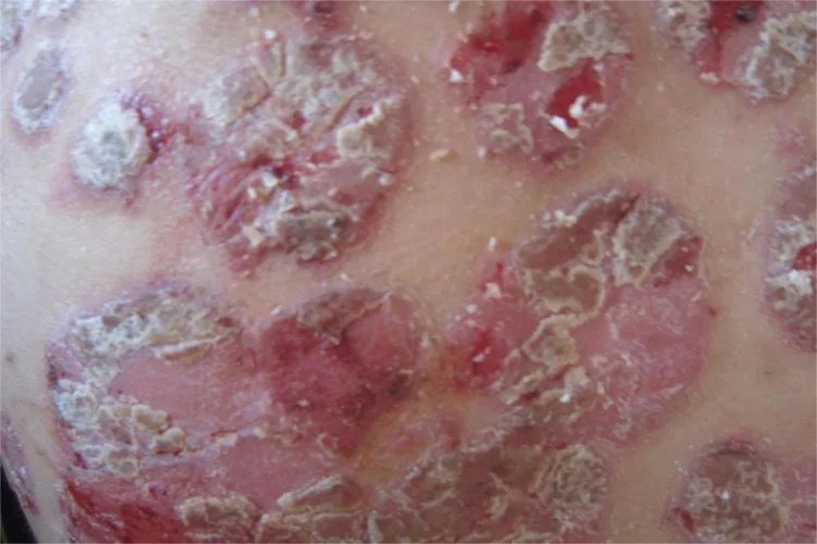 牛皮癣图片症状是什么