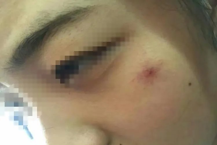 乙肝初期小红点图片