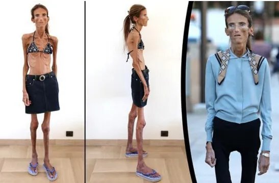 世界上最瘦的人排行榜,蒂塔万提斯排名第五(性感16寸腰)