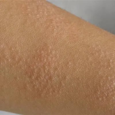 吃vb2后浑身搔痒是什么原因