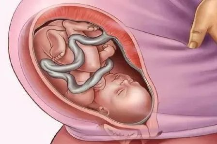 胎位图片