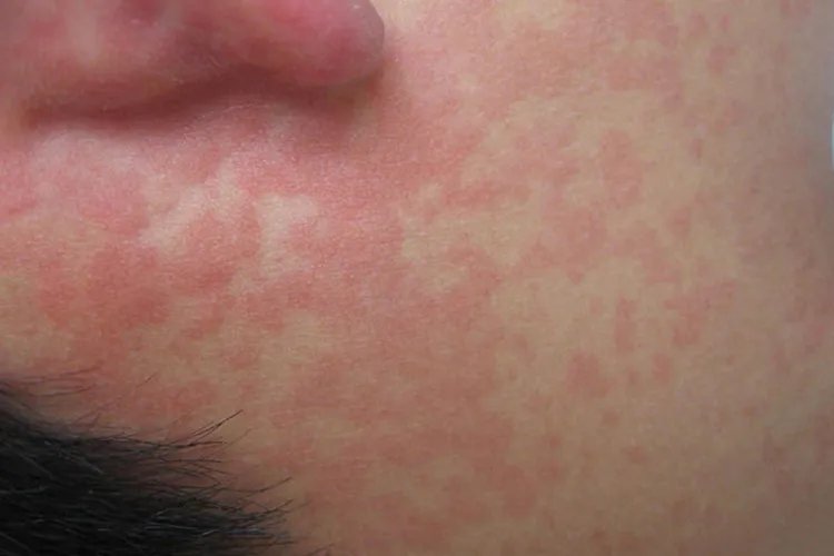 皮丘疹图片大全