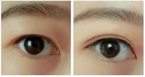 修复失败双眼皮