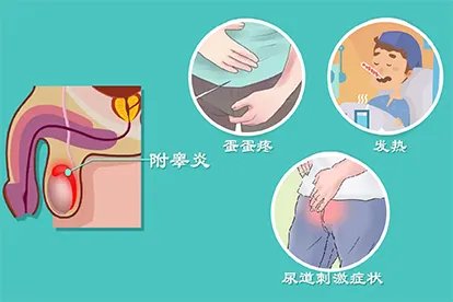 附睾炎图片