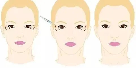 长久除皱的方法有哪些呢？