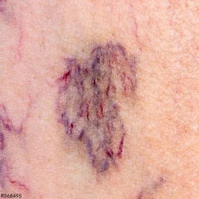 色素性紫癜怎么办