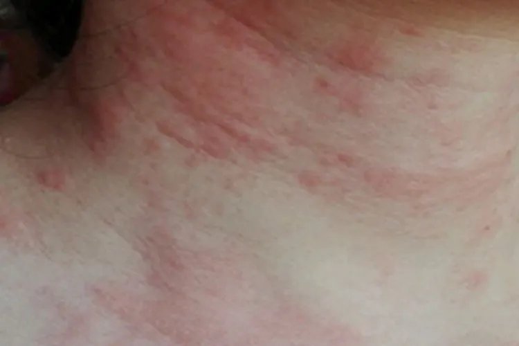 皮丘疹图片大全