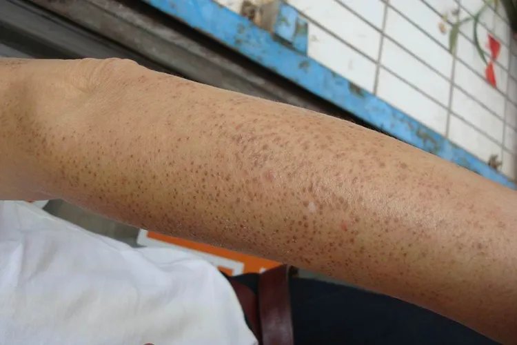 身上长鸡皮肤图片