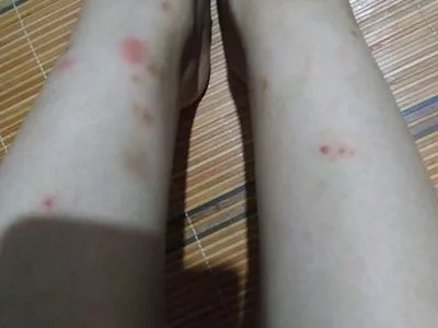 跳蚤叮咬疙瘩图片