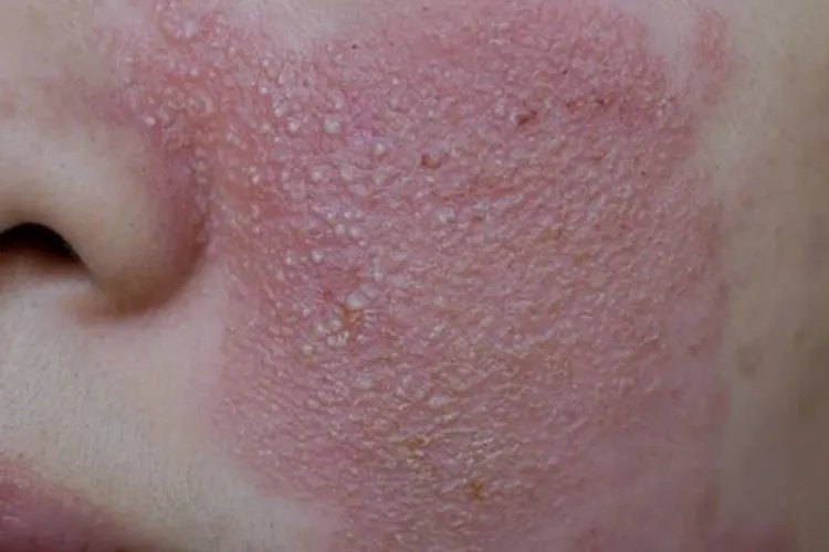 脸过敏的症状是什么样子的