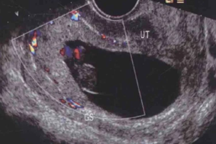 怀孕2个月胎儿图