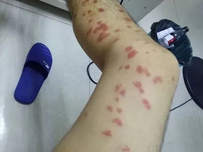 跳蚤叮咬疙瘩图片