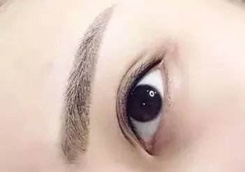 去除眼袋手术疼吗