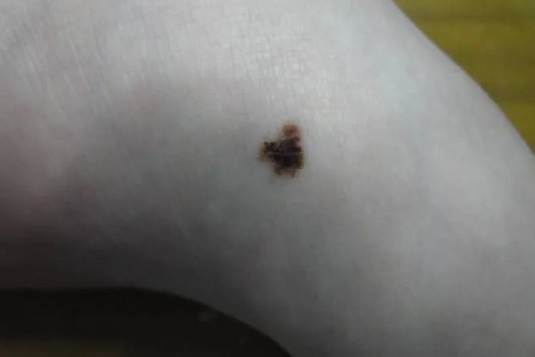 正常痣的样子图片