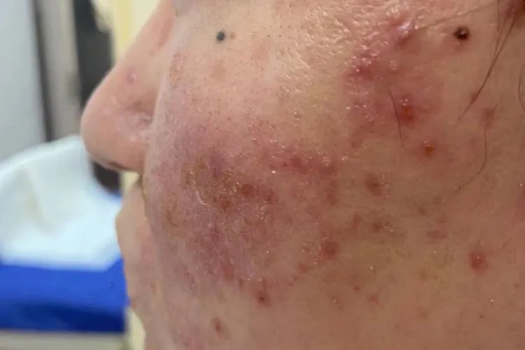 脸过敏的症状是什么样子的