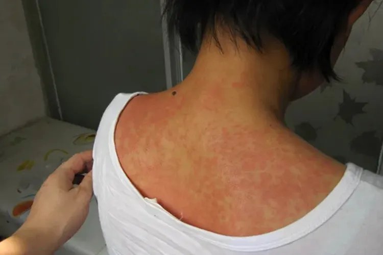 身上长了很多红色的包很痒图片