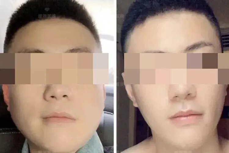 男士打瘦脸针前后对比照片