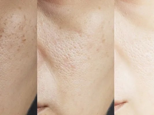 角膜白斑怎么办