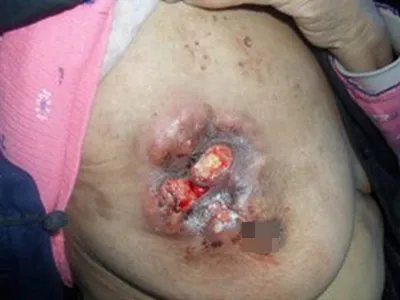乳腺癌症状图片