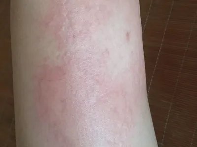 皮肤过敏红肿胳膊症状图片
