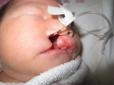 唇腭裂症状图片