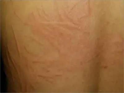 人工荨麻疹症状图片