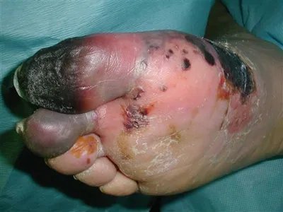 气性坏疽症状图片