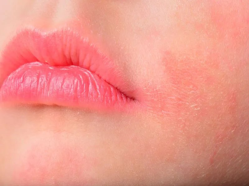 粉瘤感染的原因