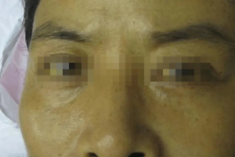 肝炎早期症状是什么样