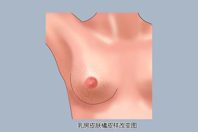 乳腺图片