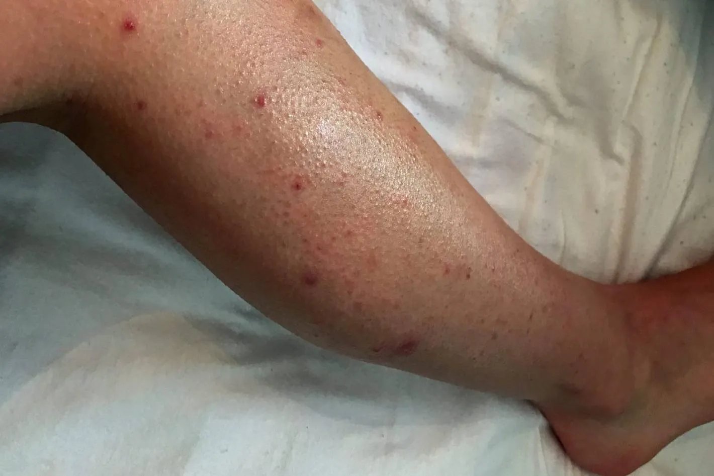 大肠杆菌皮肤病图片