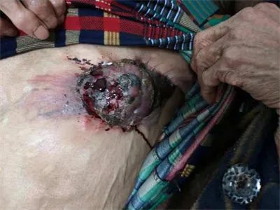 乳腺癌症状图片