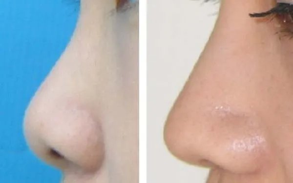 天津整形医院哪家做隆鼻好