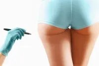 臀部抽脂价格多少