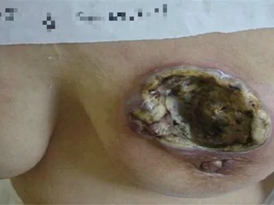 乳腺癌症状图片