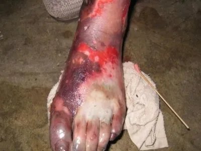 气性坏疽症状图片