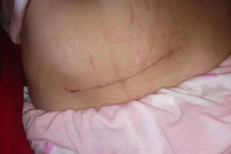剖腹产后的肚子图片