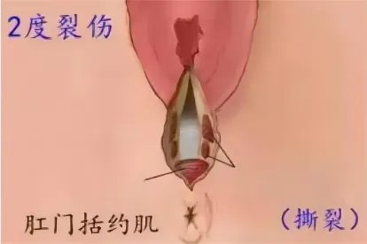 顺产二度撕裂缝合图